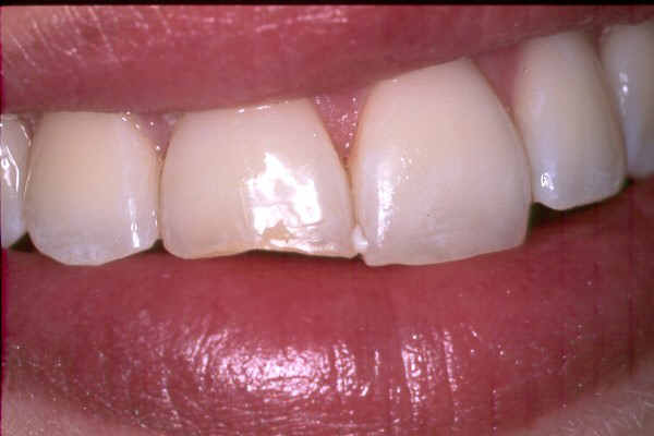 frattura dentale non complicata